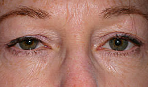 Eyelid and Forehead Lifting before