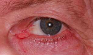 Eyelid and Orbital Injury after