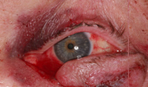 Eyelid and Orbital Injury before