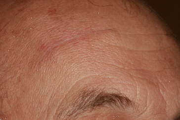 Right Side Mid-Brow Scars