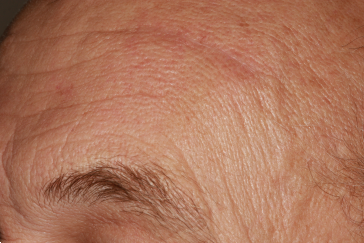 Left Side Mid-Brow Scars