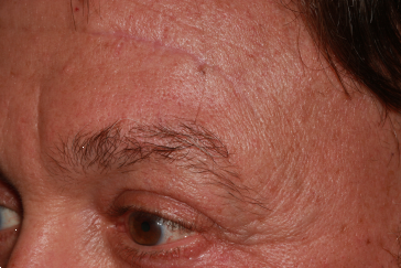 Left Side Mid-Brow Scars