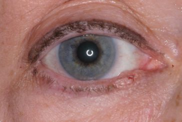 Right lower eyelid basal cell carcinoma