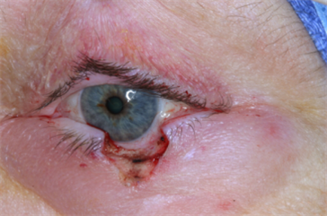 Left lower eyelid wedge defect