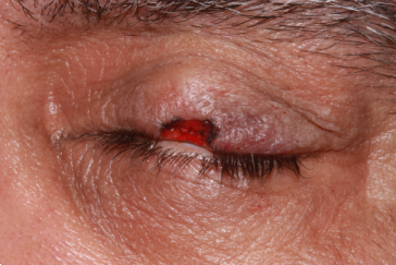 Left upper eyelid Mohs' defect