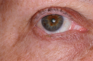 Photos of Eyelid Margin - Medium | Eyelid Plastic Surgery