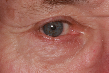 Photos of Eyelid Margin - Medium | Eyelid Plastic Surgery