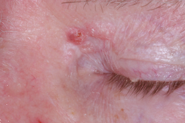 Basal cell carcinoma of medial canthus and Left upper eyelid