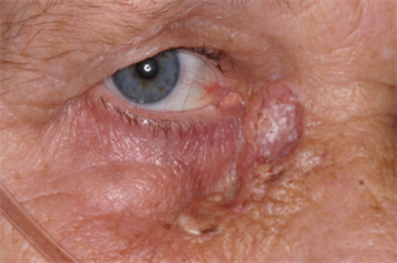 Large basal cell carcinoma