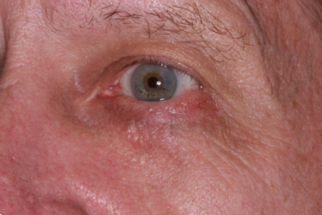 3 months after repair with left lower eyelid flap