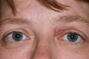1 month after left upper eyelid reconstruction