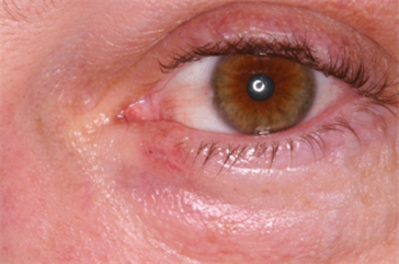 Photos of Eyelid Nonmarginal - Medium | Eyelid Plastic Surgery