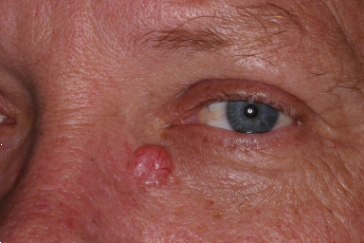 Basal cell carcinoma left lower eyelid, nose and medial canthus