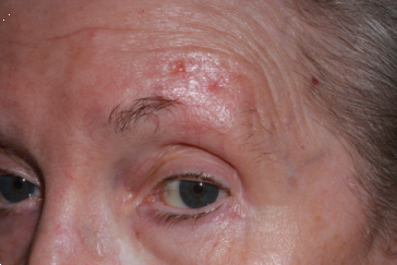 Basal cell carcinoma of brow