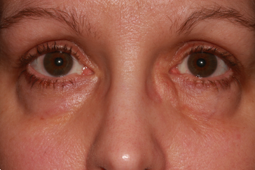 Medial canthal (inside corner of eye/side of nose) fullness from fluid collection in left lacrimal sac