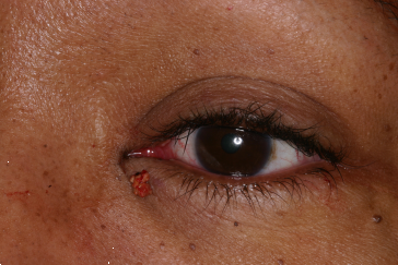 Stones (deposits) removed during left lower eyelid punctoplasty (widening of tear duct opening in eyelid)
