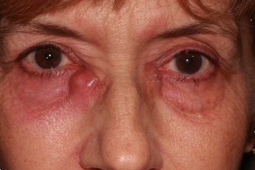 Bilateral swelling, redness, tenderness in medial canthal area (inside corner of eye/side of nose)