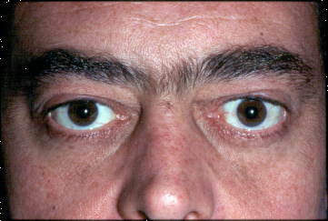Bilateral Lower Eyelid Retraction