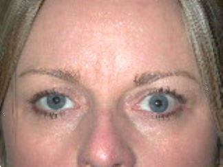 Left Upper Eyelid Retraction