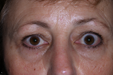 Left Upper Eyelid Retraction