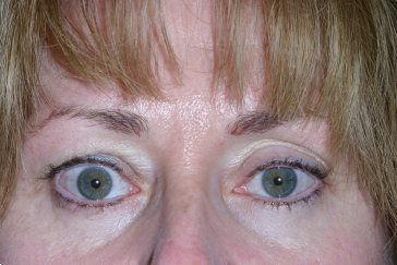 Right Upper Eyelid Retraction