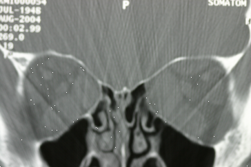 CT Scan coronal image showing large eye muscles