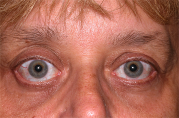 Bilateral Proptosis (Bulging Eyes)