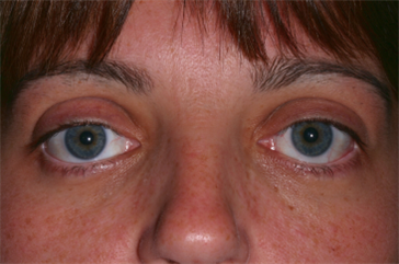 After Orbital Decompression and Eyelid Retraction Repair