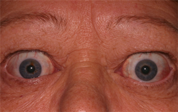 Bilateral Proptosis (Bulging Eyes) and Bilateral Retraction
