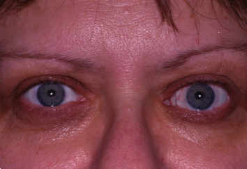 After Left Eye Orbital Decompression and Left Eyelid Retraction Repair