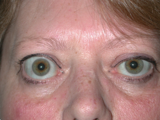 Right Proptosis (Bulging Eye)