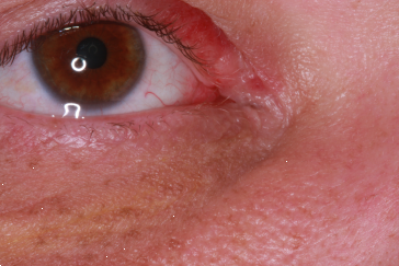 Before Repair showing notch in inner aspect of right upper eyelid
