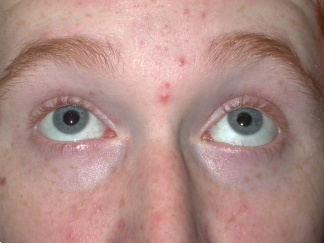 After orbital fracture repair showing normal upgaze right eye