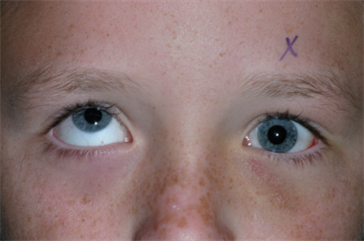 Severe limitation of upgaze left eye