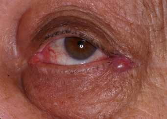 Ectropion 85 year old after.jpg