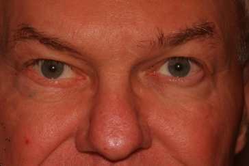 Photos of Ectropion Surgery - Paralytic | Eyelid Plastic Surgery