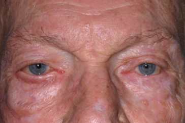 Cicatrical Ectropion 91 year old after.jpg