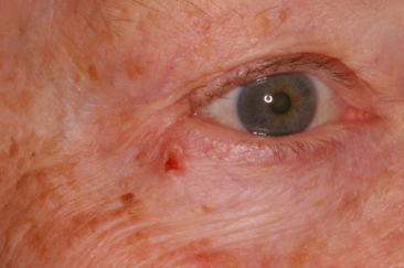 Basal cell carcinoma