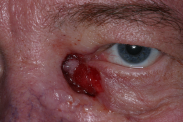 Basal cell carcinoma