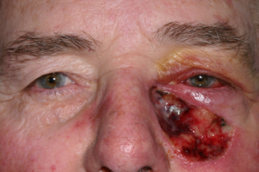 Large basal cell carcinoma defect