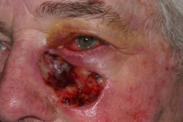 Large basal cell carcinoma defect