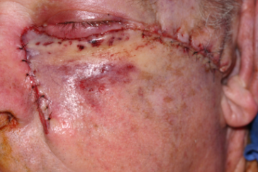 Intra-operative Wound Closure