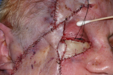 Intraoperative flaps and grafts