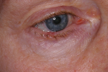 Basal cell carcinoma