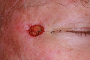 Lateral canthal basal cell carcinoma Mohs' defect