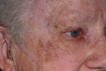 Lentigo malignant melanoma