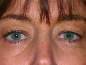 Blepharoplasty Surgery before