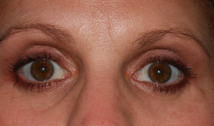 Blepharoplasty Surgery after