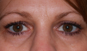 Blepharoplasty Surgery before