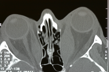 CT Scan axial image showing large medial rectus muscles